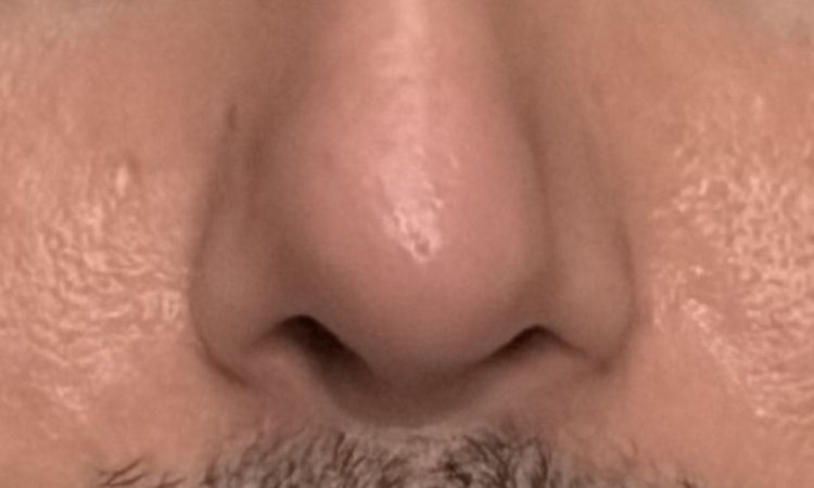 Hallo, ich hatte vor 19 Tagen eine Septorhinoplastik. - 84642