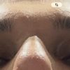 Hallo, ich hatte vor 19 Tagen eine Septorhinoplastik.
