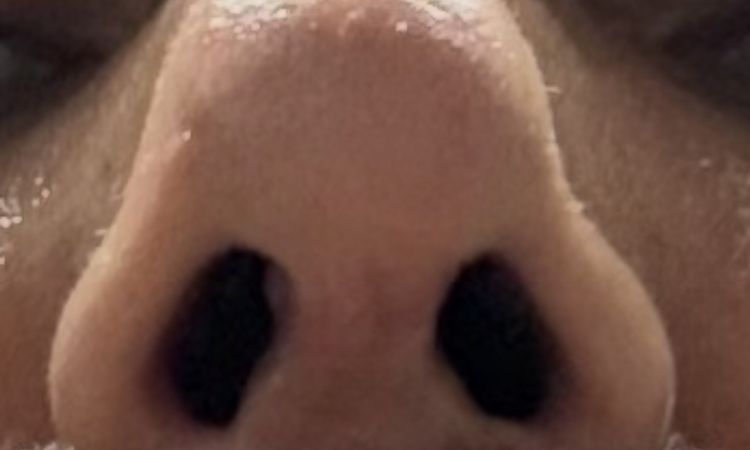 Hallo, ich hatte vor 19 Tagen eine Septorhinoplastik. - 84643