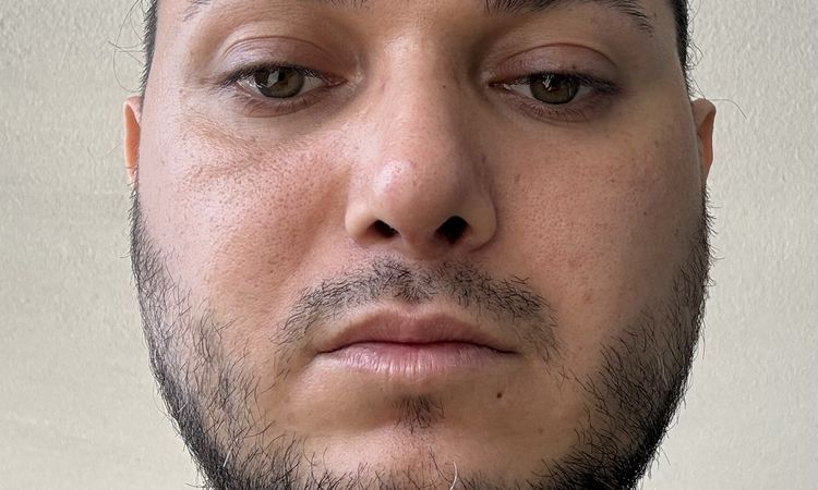 Hallo, ich hatte vor 19 Tagen eine Septorhinoplastik. - 84644