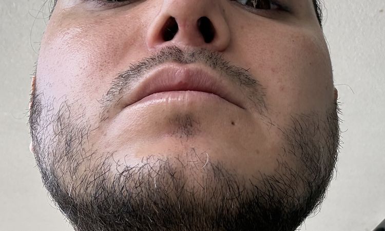 Hallo, ich hatte vor 19 Tagen eine Septorhinoplastik. - 84645