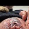Hubbel nach Schamlippenverkleinerung