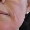 Lymphstau Monate nach Hyaluronfiller in Marionettenfalten
