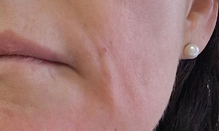 Lymphstau Monate nach Hyaluronfiller in Marionettenfalten - 84683