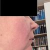 Reicht HiFu / MiFu oder Lifting notwendig ?