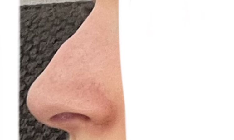 Delle und Hubbel 9 Wochen nach Nasen-OP – kann sich das noch verändern? - 84783