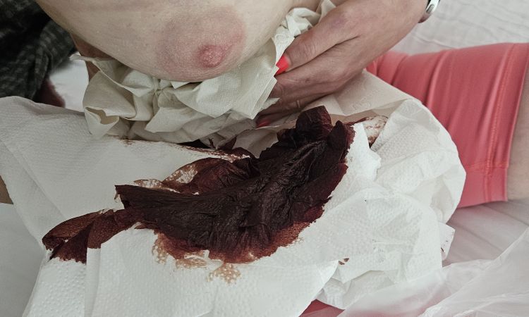 Hämatom nach Brustvergrößerung - 84793