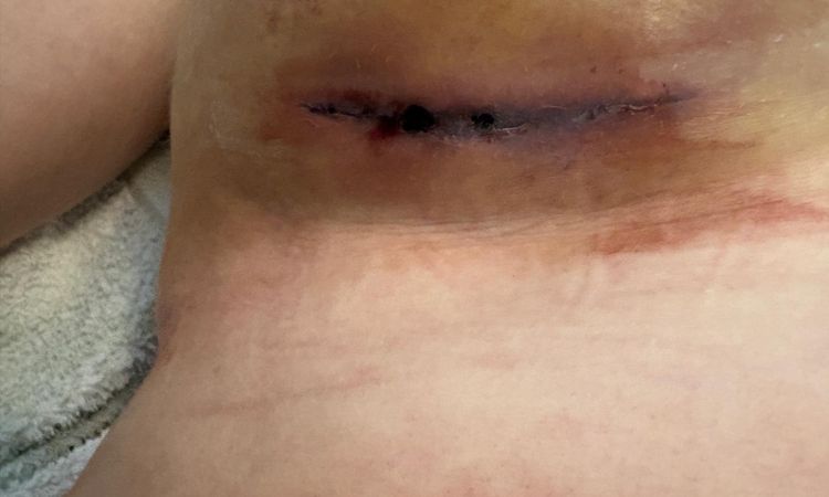 Hämatom nach Brustvergrößerung - 84794
