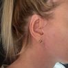 Vernarbung nach Facelift
