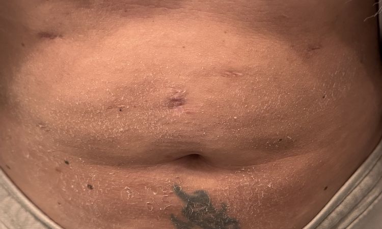 Ist eine noch vorhandene Wulst oberhalb des Bauchnabels.. - 84831