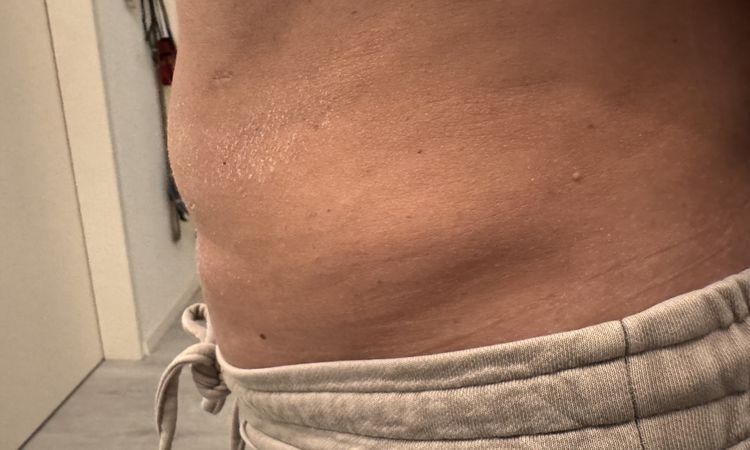Ist eine noch vorhandene Wulst oberhalb des Bauchnabels.. - 84832