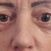 Blepharoplastik Ober- Unterlid mit Lidheberverkürzung kombiniert