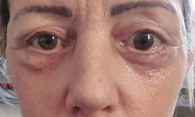 Blepharoplastik Ober- Unterlid mit Lidheberverkürzung kombiniert - 84852