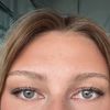 Botox Stirn bei Schlupflidern
