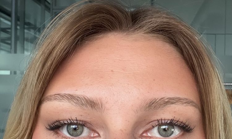 Botox Stirn bei Schlupflidern - 84861