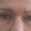Oberlidstraffung Auge zu straff genäht. Geht das noch weg?