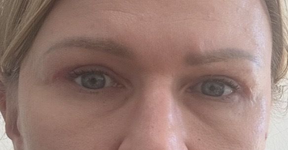 Oberlidstraffung Auge zu straff genäht. Geht das noch weg? - 84971