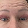 Oberlidstraffung Auge zu straff genäht. Geht das noch weg?