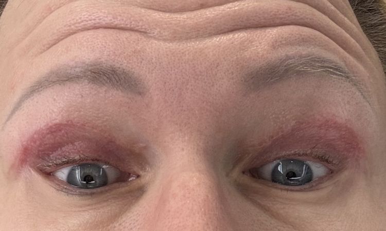 Oberlidstraffung Auge zu straff genäht. Geht das noch weg? - 84972