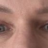 Oberlidstraffung Auge zu straff genäht. Geht das noch weg?