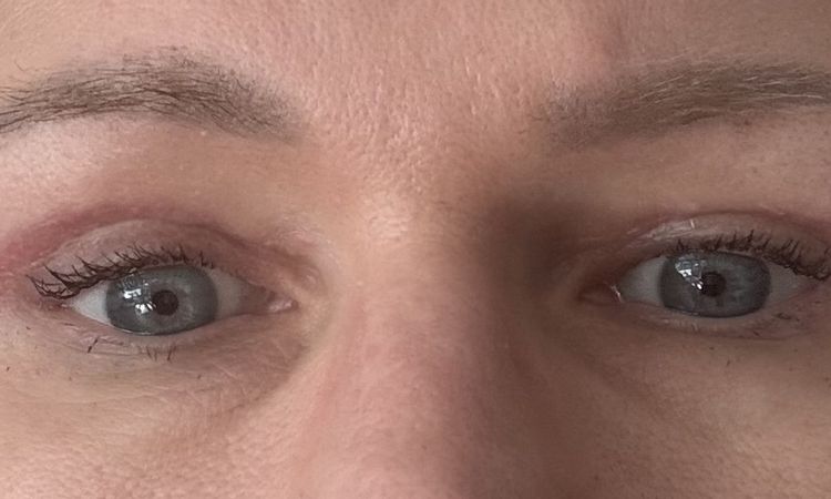 Oberlidstraffung Auge zu straff genäht. Geht das noch weg? - 84973