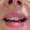Knötchen in der Lippe nach Lip Filler mit Fillmed