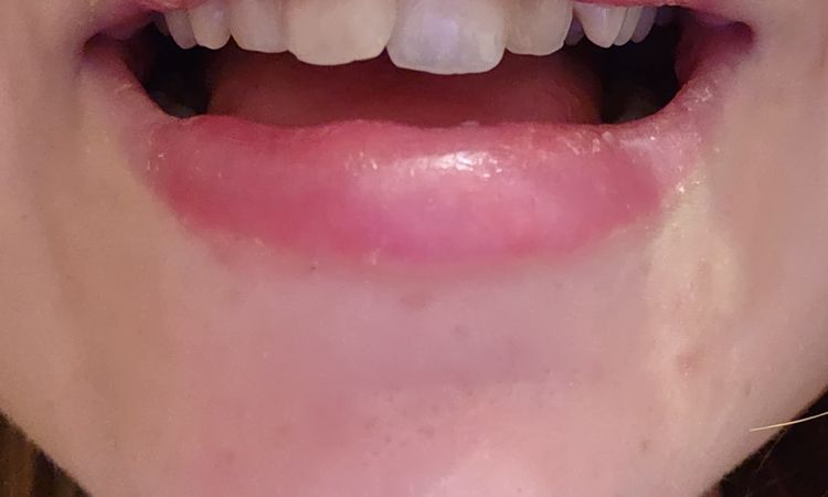 Knötchen in der Lippe nach Lip Filler mit Fillmed - 84974