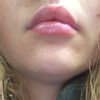 Knötchen in der Lippe nach Lip Filler mit Fillmed