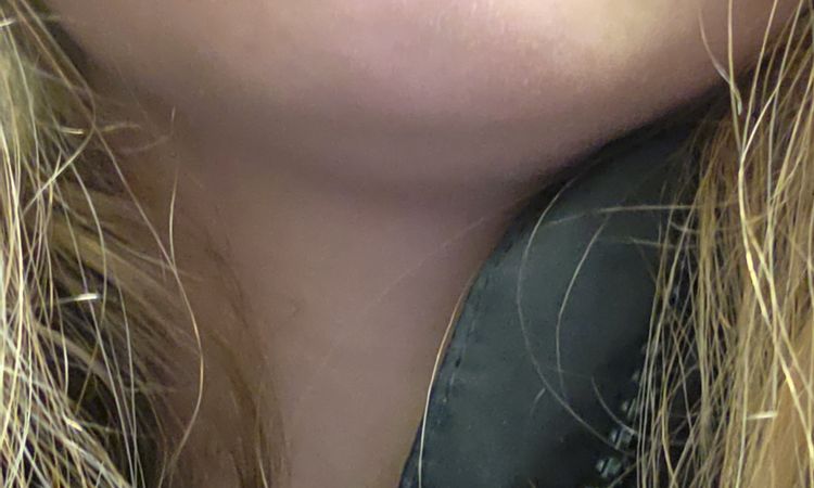 Knötchen in der Lippe nach Lip Filler mit Fillmed - 84975