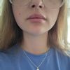 Knötchen in der Lippe nach Lip Filler mit Fillmed