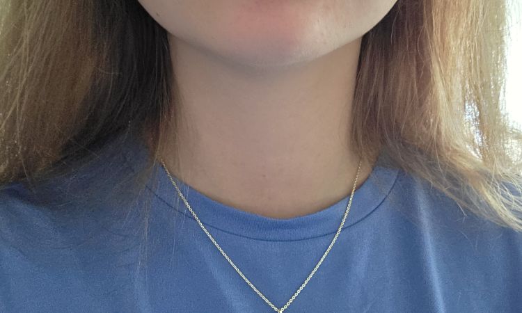 Knötchen in der Lippe nach Lip Filler mit Fillmed - 84976