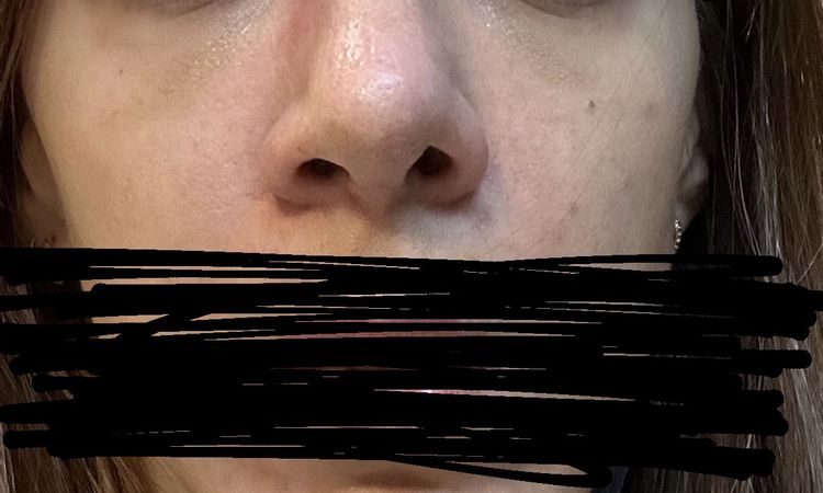 Asymmetrische Nase nach Nasenop - 85041