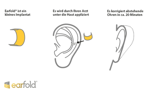 Earfold® Implantat