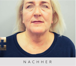 Patientin nach der Fett-weg-Spritze - Priv.-Doz. Dr. Georg M. Huemer