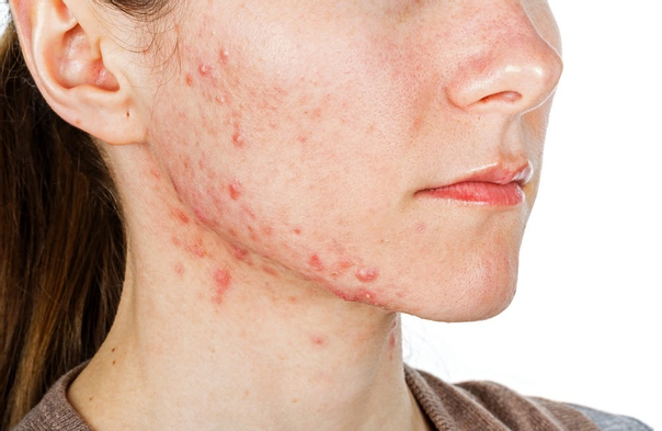 Wie behandelt man Akne