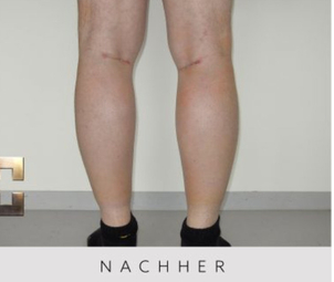 Ergebnis einer Implantateinsetzung