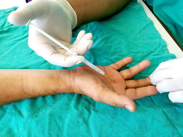 Injektionen sind die häufigste Behandlung gegen Schnappfinger