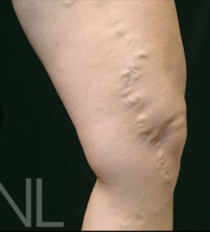 Krampfaderbehandlung