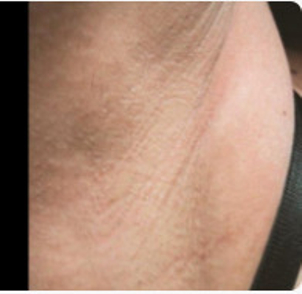 Vorher-Nachher Bild der Haarentfernung in der Achsel - Candela