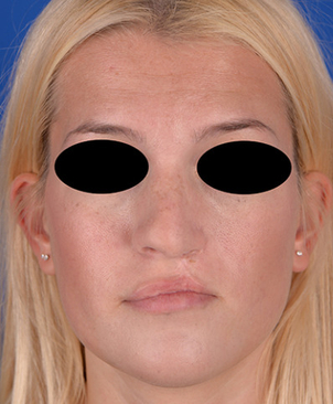 Patientin wurde mit einer Lippen – Kiefer – Gaumenspalte geboren - Prof. Dr. med. Holger Gassner