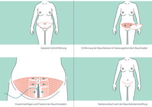 Ablauf der Operation - DGPRäC