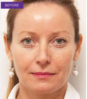 Vor der Botoxunterspritzung