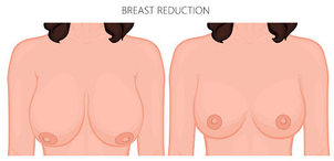 Wie läuft die Bruststraffung ab?