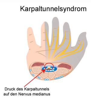 Was ist das Karpaltunnelsyndrom?