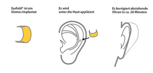 Earfold® Vorgehensweise - Foto: Dr. med. Andre Generalow