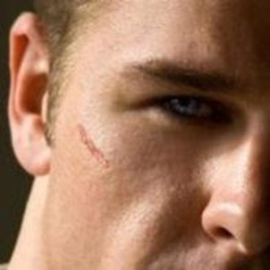 Um Narben zu beseitigen, erweist sich die Laserbehandlung als sehr vielversprechend