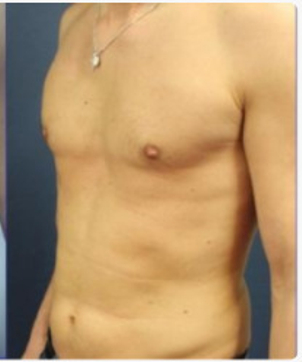 Sowohl Männer als Frauen nutzen die Technik der Kryolipolyse - Dr. Martin Barsch MBA