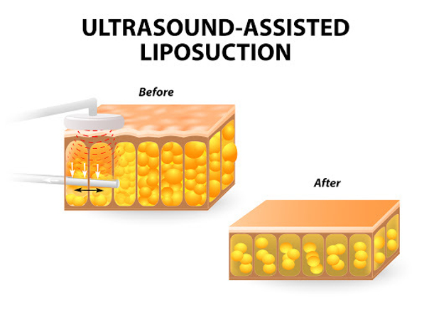 ultraschallunterstützte Liposuktion