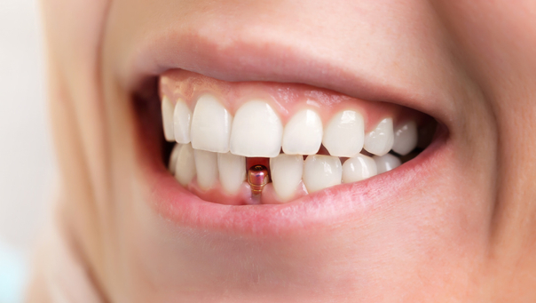 Implantate können in ein frisches Loch nach einem gerade gezogenen Zahn sowie in einem bereits länger zahnlosen Kiefer eingesetzt werden