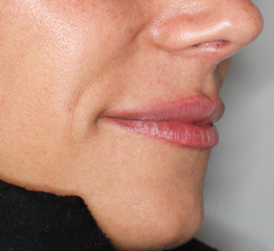 Dezente Konturierung der Oberlippe - Dr.med. Thorsten Sattler